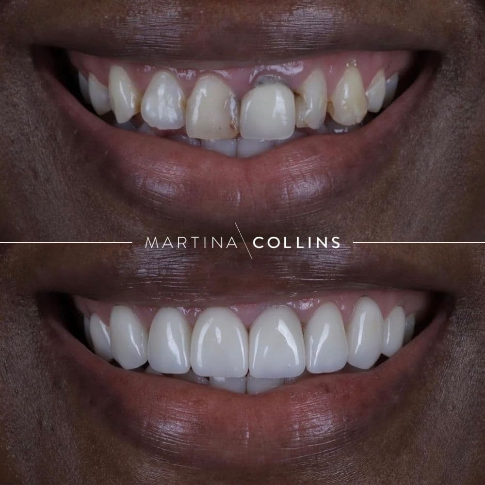 Dr. David Porcelian Veneers (4).jpg