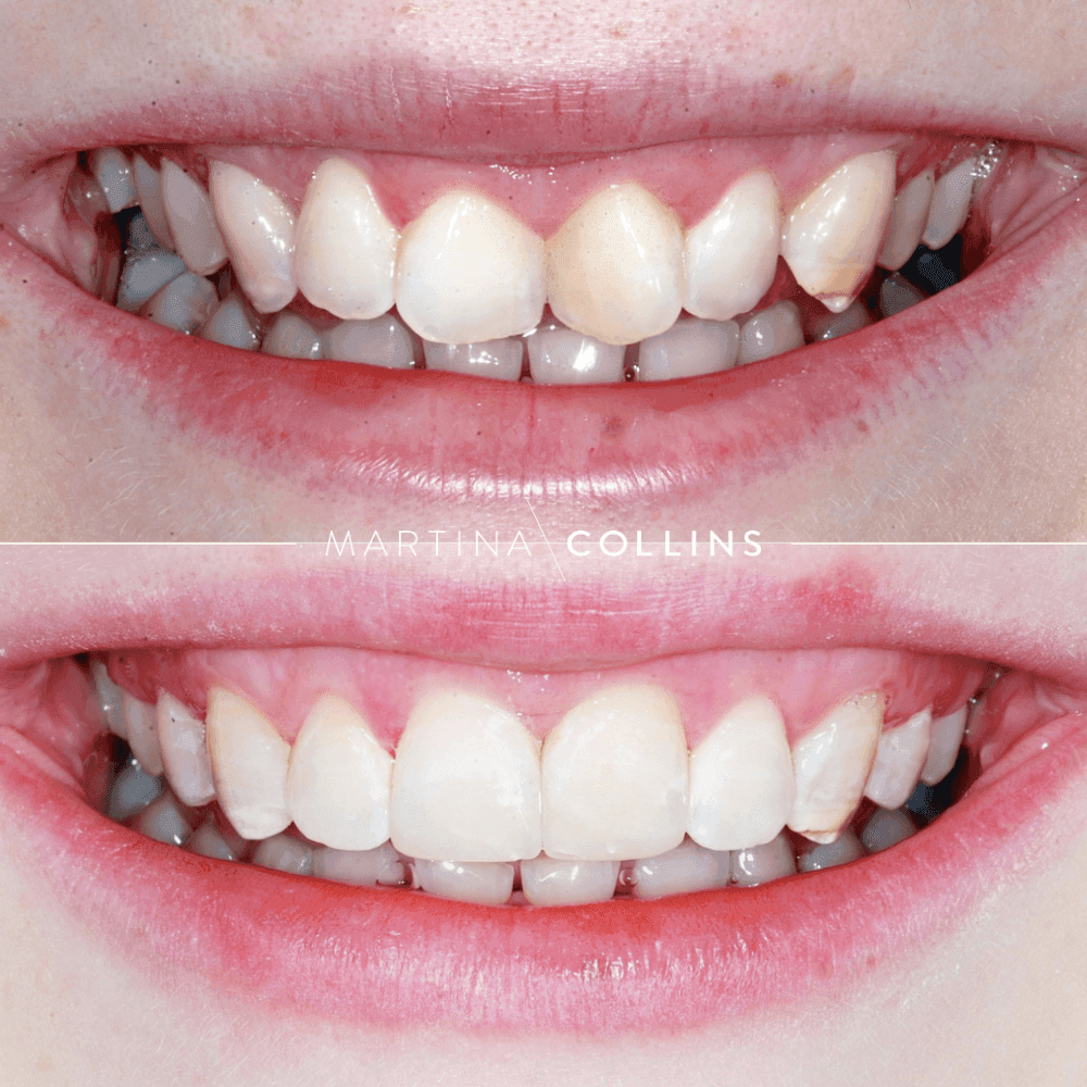 Braces - Dr. Darren.png