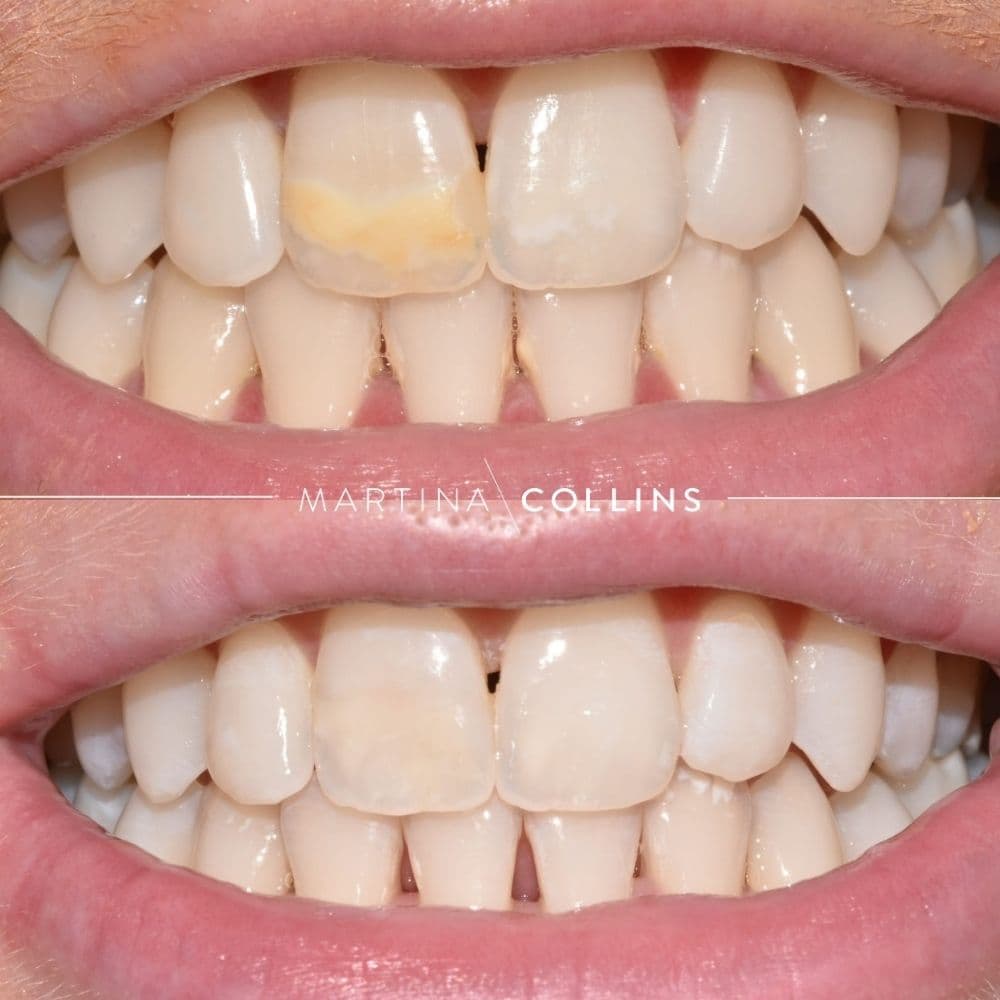 Darren Fluorosis Correction.jpg