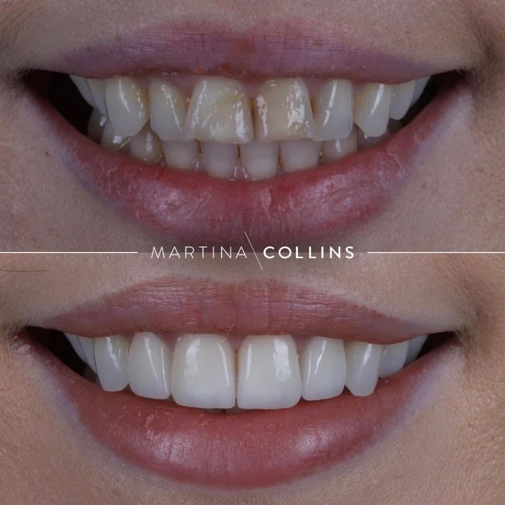 Dr. David Porcelian Veneers (2).jpg