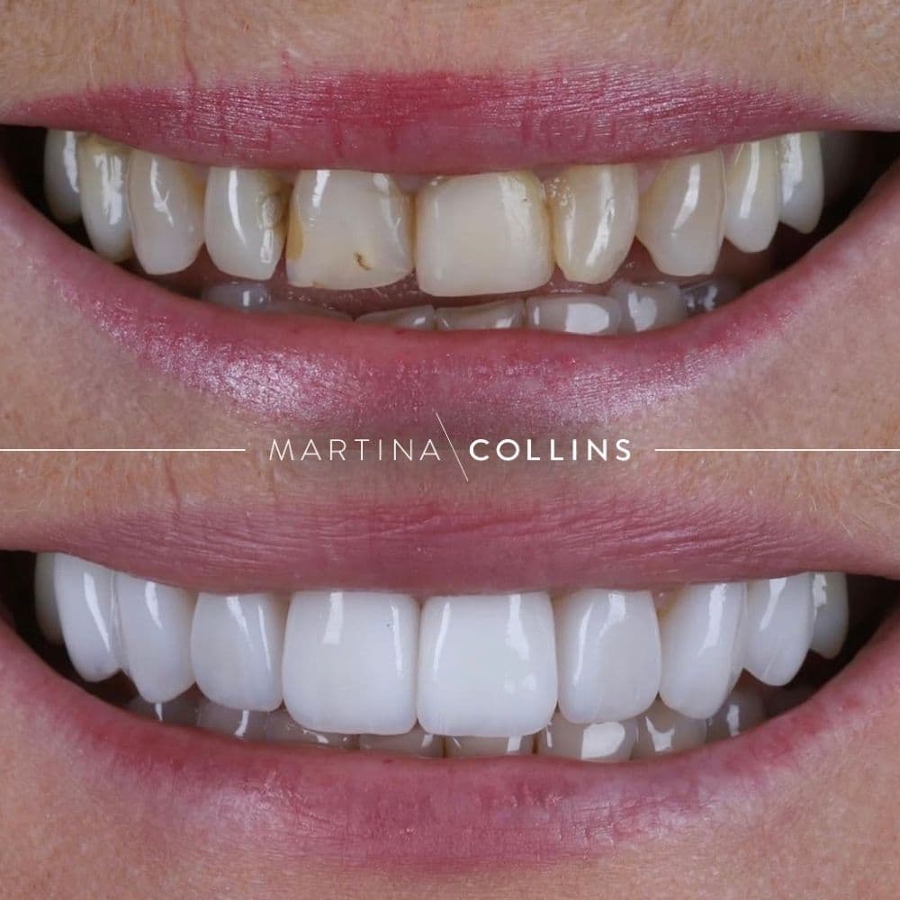 Dr. David Porcelian Veneers (3).jpg